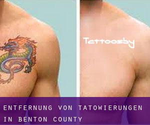 Entfernung von Tätowierungen in Benton County