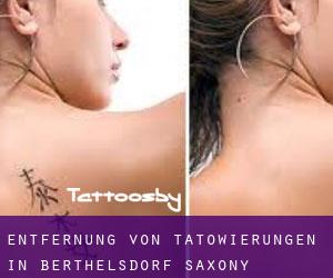 Entfernung von Tätowierungen in Berthelsdorf (Saxony)