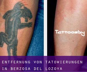 Entfernung von Tätowierungen in Berzosa del Lozoya