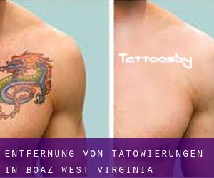 Entfernung von Tätowierungen in Boaz (West Virginia)