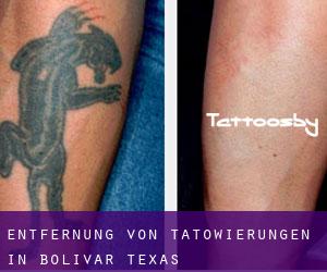 Entfernung von Tätowierungen in Bolivar (Texas)