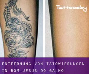 Entfernung von Tätowierungen in Bom Jesus do Galho