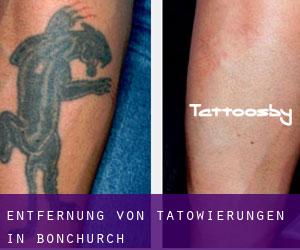 Entfernung von Tätowierungen in Bonchurch