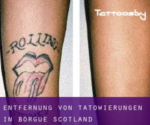 Entfernung von Tätowierungen in Borgue (Scotland)