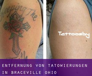 Entfernung von Tätowierungen in Braceville (Ohio)