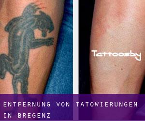 Entfernung von Tätowierungen in Bregenz