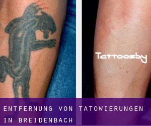 Entfernung von Tätowierungen in Breidenbach