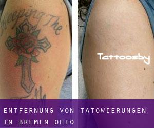 Entfernung von Tätowierungen in Bremen (Ohio)