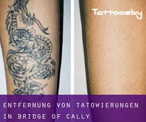 Entfernung von Tätowierungen in Bridge of Cally