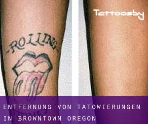 Entfernung von Tätowierungen in Browntown (Oregon)