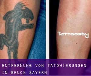 Entfernung von Tätowierungen in Brück (Bayern)