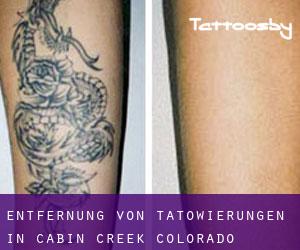 Entfernung von Tätowierungen in Cabin Creek (Colorado)