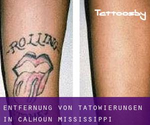 Entfernung von Tätowierungen in Calhoun (Mississippi)