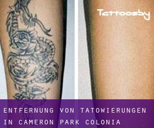 Entfernung von Tätowierungen in Cameron Park Colonia