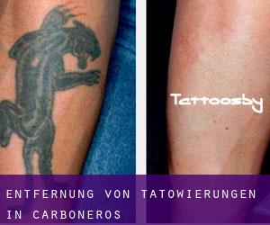 Entfernung von Tätowierungen in Carboneros