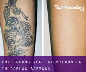 Entfernung von Tätowierungen in Carlos Barbosa