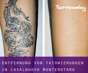 Entfernung von Tätowierungen in Casalnuovo Monterotaro