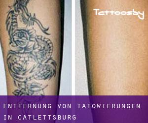 Entfernung von Tätowierungen in Catlettsburg