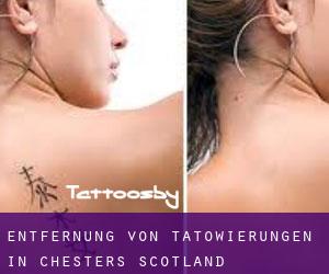 Entfernung von Tätowierungen in Chesters (Scotland)