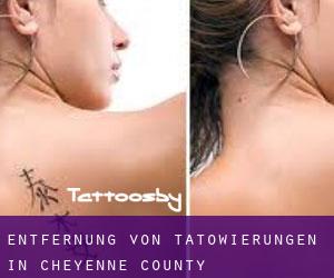 Entfernung von Tätowierungen in Cheyenne County