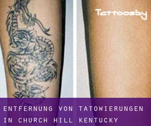 Entfernung von Tätowierungen in Church Hill (Kentucky)