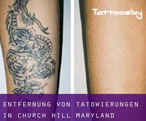 Entfernung von Tätowierungen in Church Hill (Maryland)