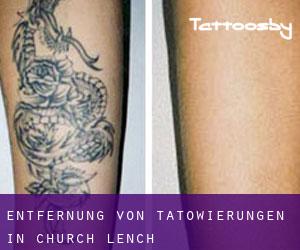 Entfernung von Tätowierungen in Church Lench