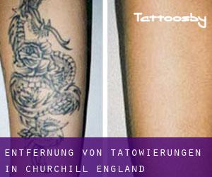 Entfernung von Tätowierungen in Churchill (England)