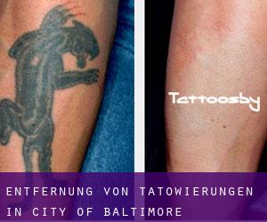 Entfernung von Tätowierungen in City of Baltimore