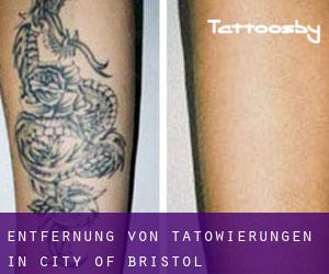 Entfernung von Tätowierungen in City of Bristol