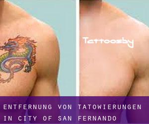 Entfernung von Tätowierungen in City of San Fernando