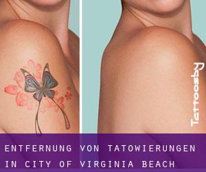 Entfernung von Tätowierungen in City of Virginia Beach