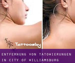 Entfernung von Tätowierungen in City of Williamsburg