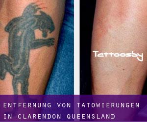 Entfernung von Tätowierungen in Clarendon (Queensland)