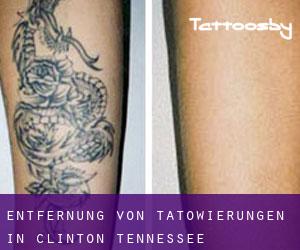 Entfernung von Tätowierungen in Clinton (Tennessee)