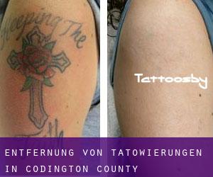 Entfernung von Tätowierungen in Codington County