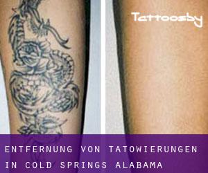 Entfernung von Tätowierungen in Cold Springs (Alabama)