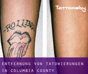 Entfernung von Tätowierungen in Columbia County