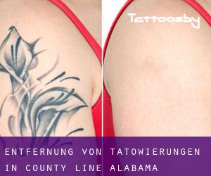 Entfernung von Tätowierungen in County Line (Alabama)