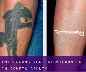 Entfernung von Tätowierungen in Coweta County