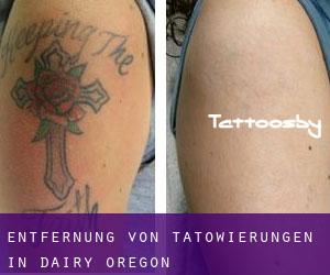 Entfernung von Tätowierungen in Dairy (Oregon)