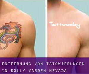 Entfernung von Tätowierungen in Dolly Varden (Nevada)