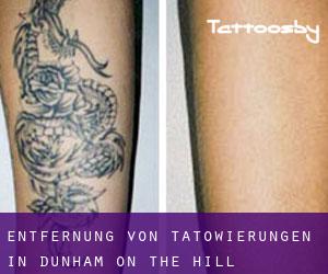 Entfernung von Tätowierungen in Dunham on the Hill