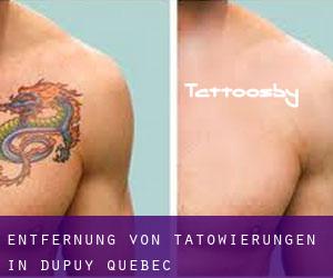 Entfernung von Tätowierungen in Dupuy (Quebec)