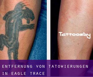 Entfernung von Tätowierungen in Eagle Trace