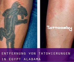 Entfernung von Tätowierungen in Egypt (Alabama)