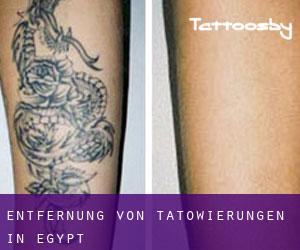 Entfernung von Tätowierungen in Egypt