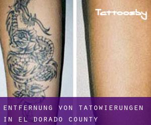 Entfernung von Tätowierungen in El Dorado County