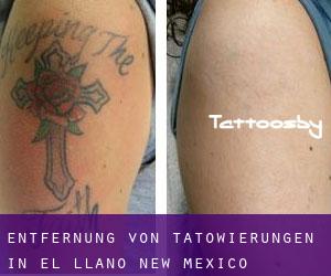 Entfernung von Tätowierungen in El Llano (New Mexico)