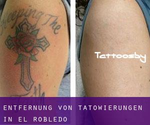 Entfernung von Tätowierungen in El Robledo
